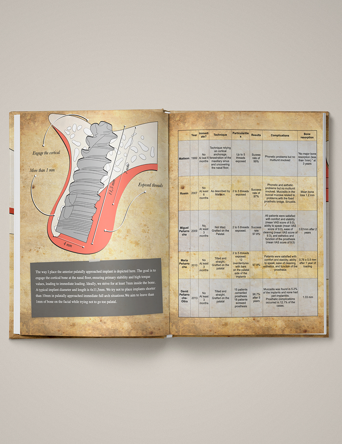 Volume 1 - Full-Arch Rehabilitation: Atrophic Maxilla & Mandible - Image 7
